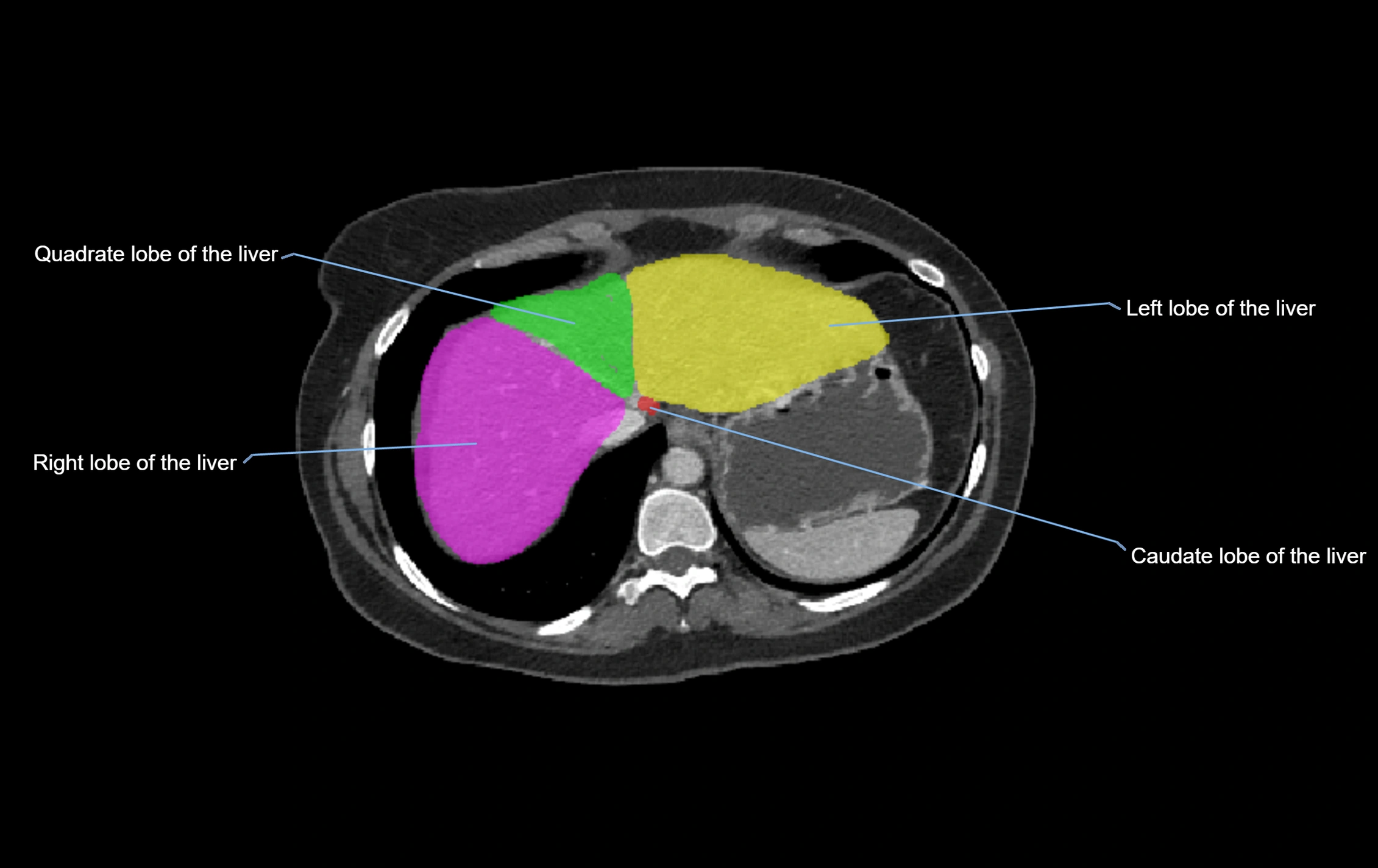 CT lliver lobes axial cross sectional anatomy labelled image -00067.webp